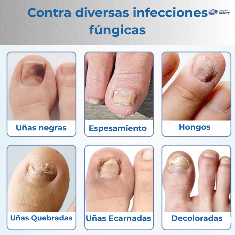 Fungal Nail Recupera el orgullo de mostrar tus pies