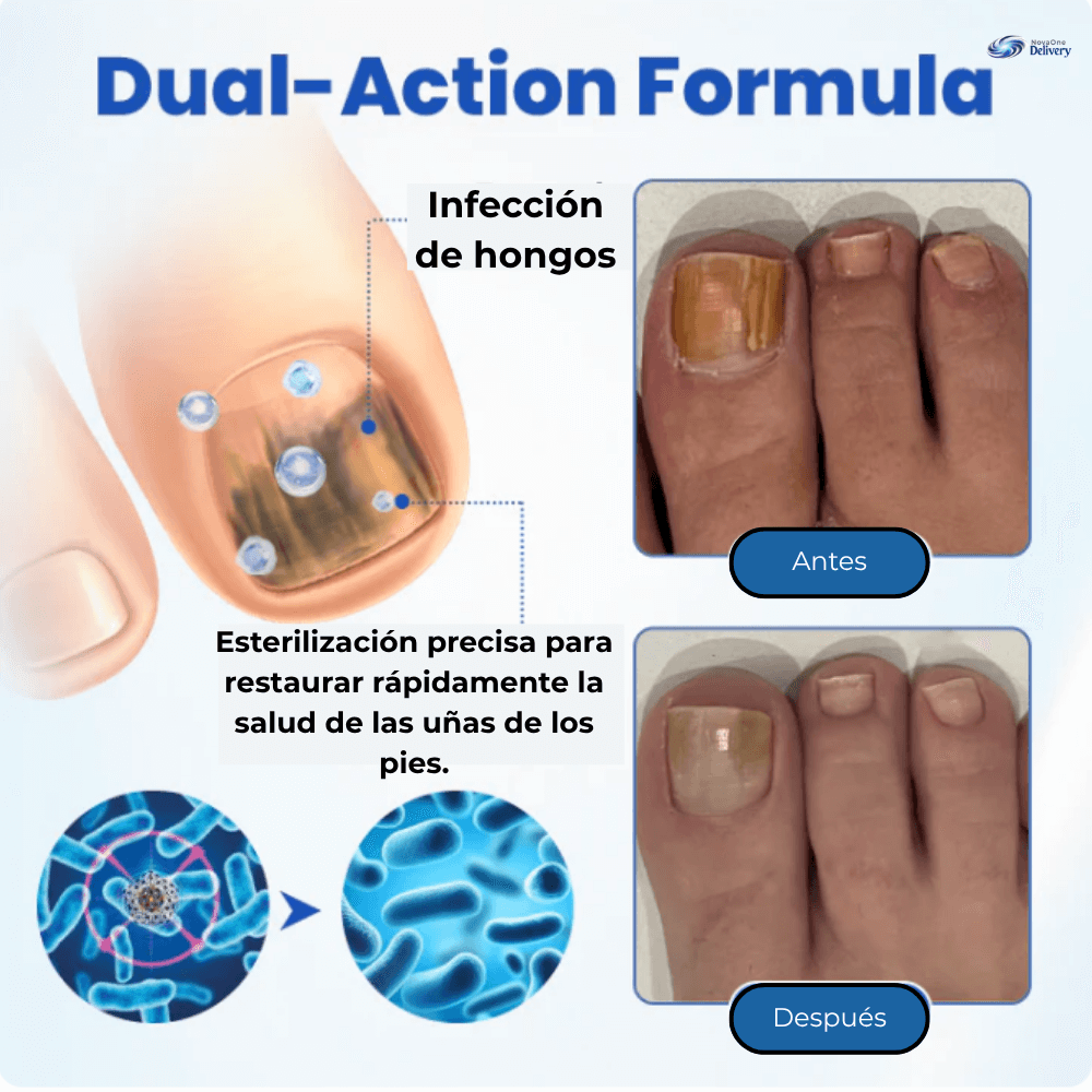 Fungal Nail Recupera el orgullo de mostrar tus pies